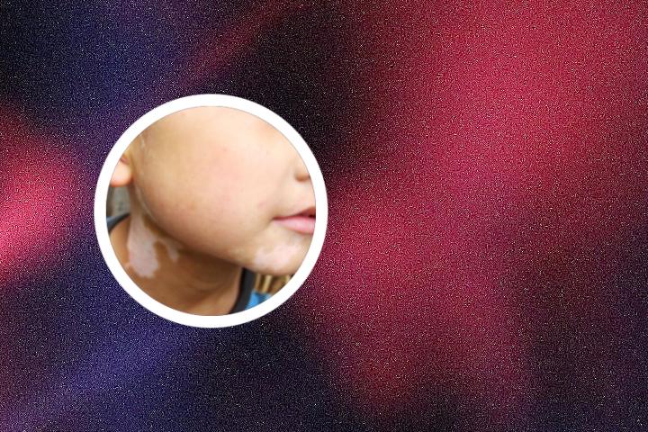 疫情对白癜风有什么影响