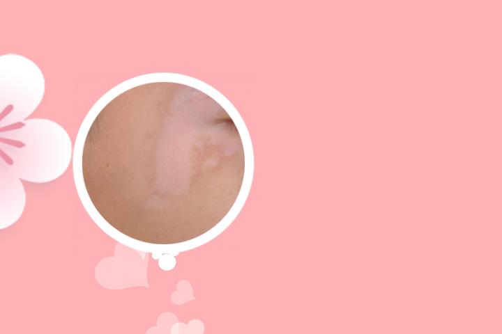 白癜风危害大全