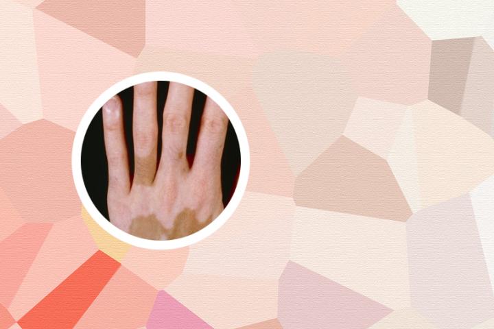 白癜风全身变白了会怎么样