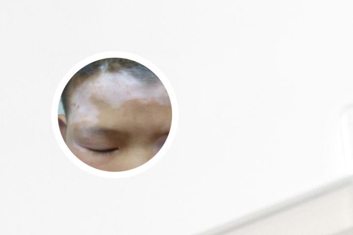 白癜风买哪种光疗仪好