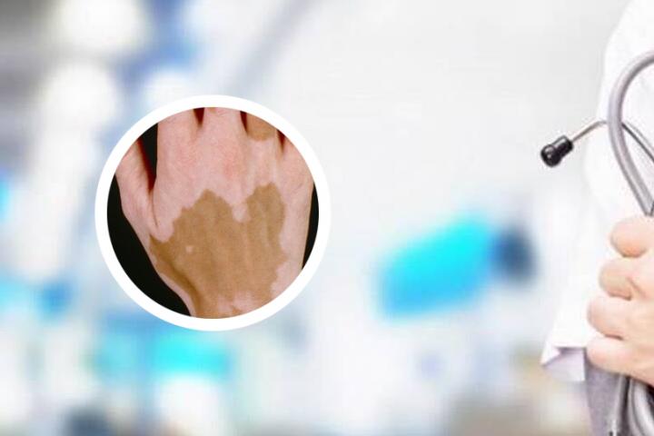白癜风患者输液可以输维c吗