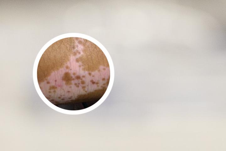 白癜风记录