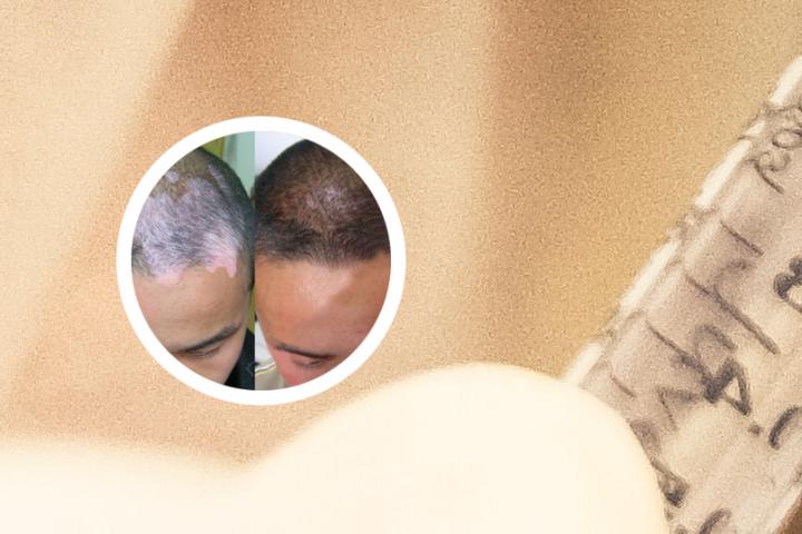 白癜风女孩追寻爱情
