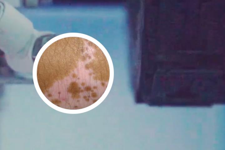 白癜风有什么好的医疗方法