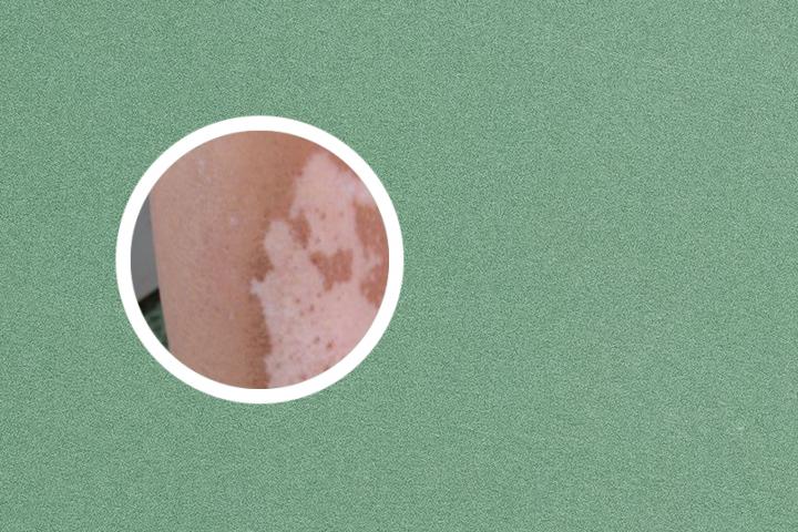 辛集专业治疗白癜风