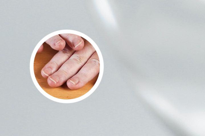 儿童白癜风传染别人吗