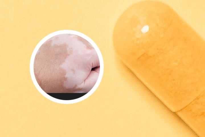 白癜风患者白斑处红