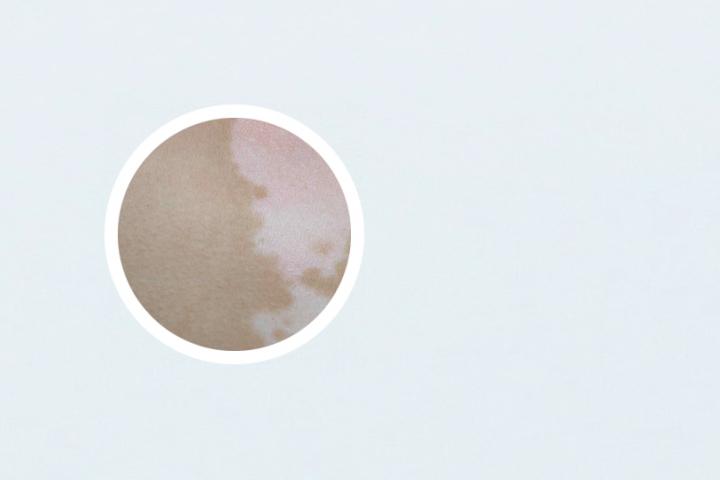 uvb白癜风治疗仪