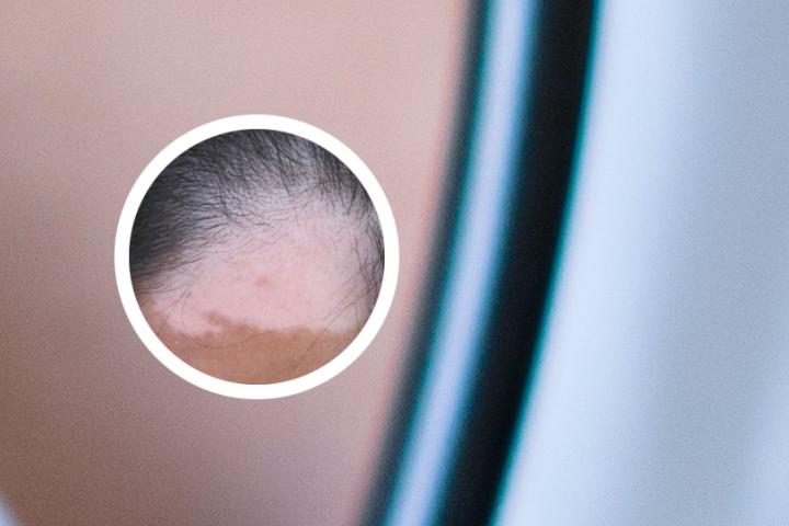 大连看白癜风好的治疗方法