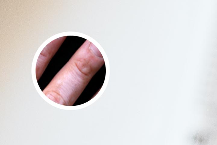 白癜风该怎么控制