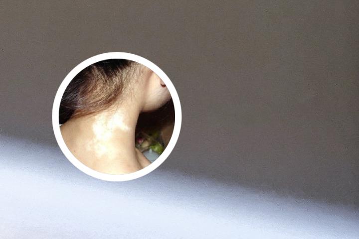 治疗白癜风有名的中医