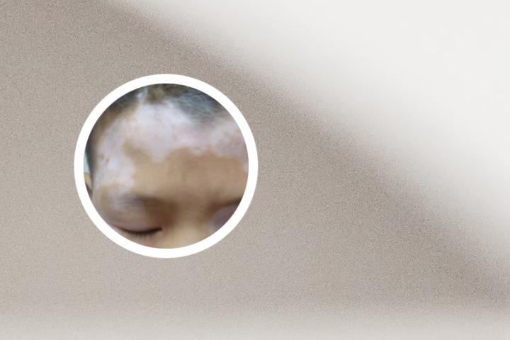 白癜风晚上总磨牙 白癜风晚上痒