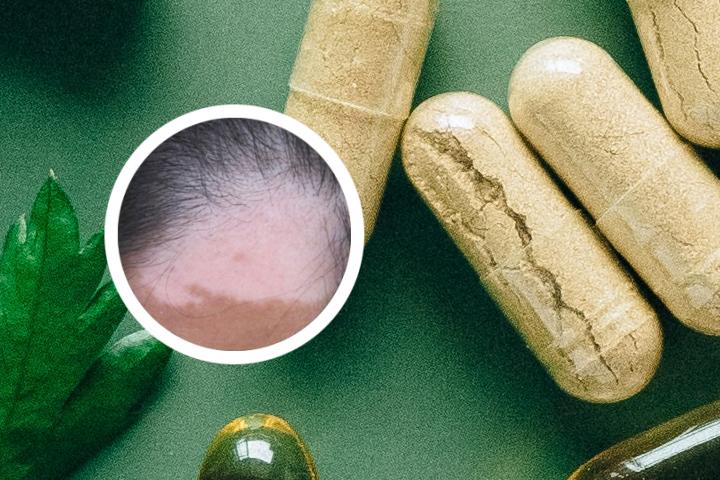 戒烟酒白癜风进入稳定期