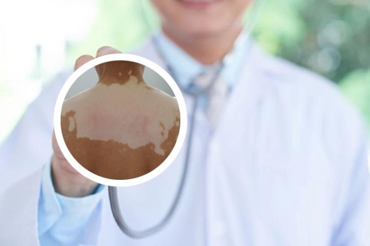 白癜风吃黑色食物有用么