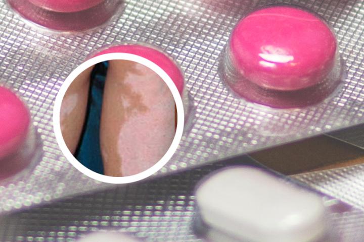 游泳馆禁止白癜风患者游泳