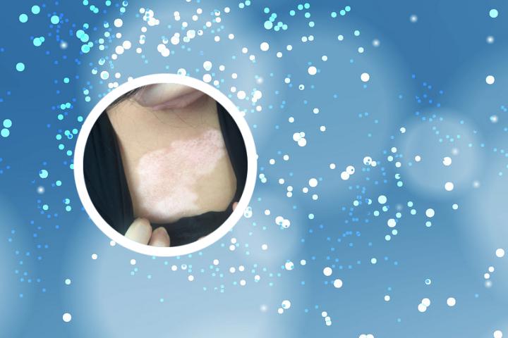 白点病和白癜风如何区别