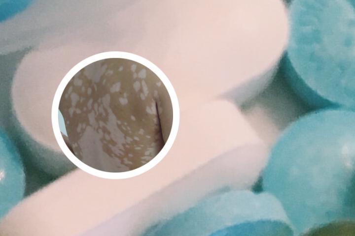 白癜风与日光斑的区别