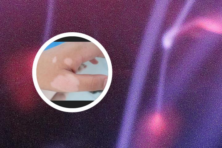 四肢白癜风是绝症么