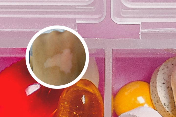 白癜风初次检查