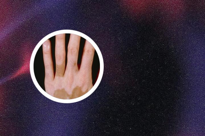白癜风与情绪