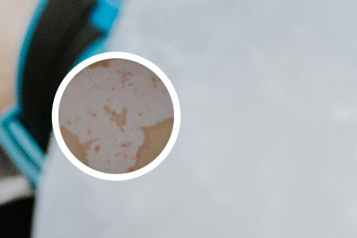 经常使用白癜风uvb的危害是什么
