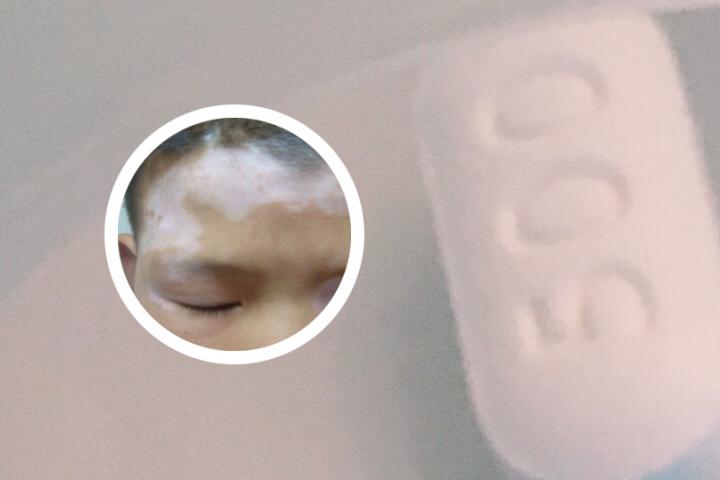白癜风会有异常吗