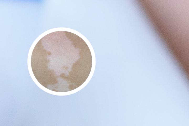 白癜风晚上能开窗户睡觉吗