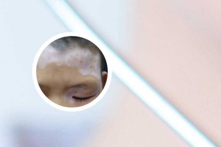 白癜风医生卢飞