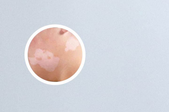 白癜风能否吃冬瓜