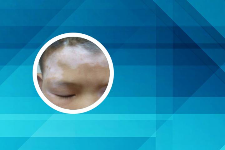 白癜风接触到了会传染吗