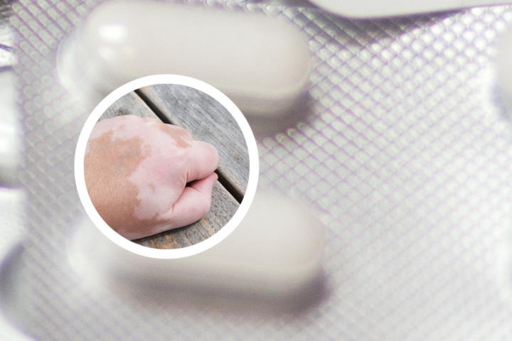 白癜风为啥不能报社保 白癜风为啥不能吃vc