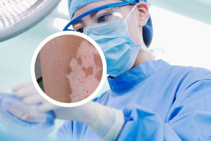 白癜风涂卤米他松软膏