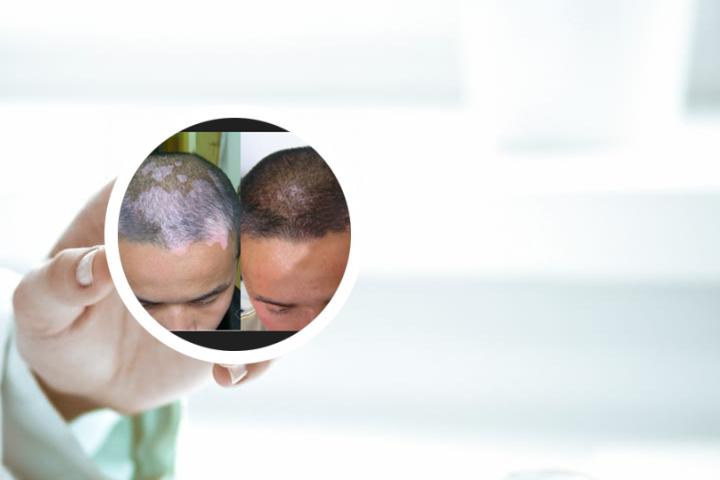 白癜风患者结婚的难度