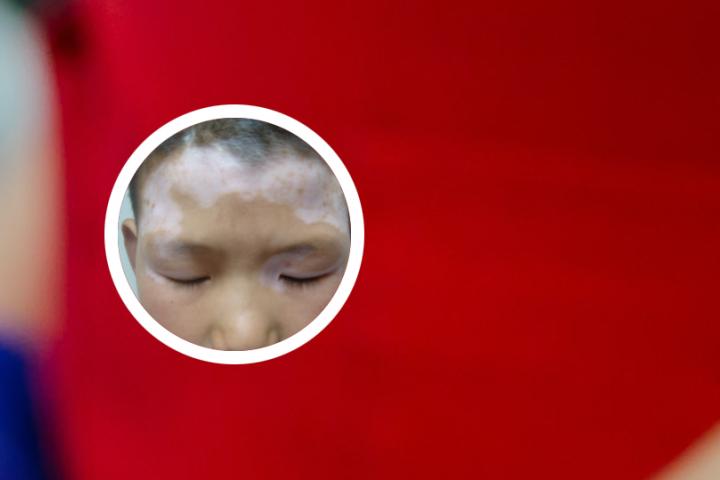 白癜风萎缩能治好吗