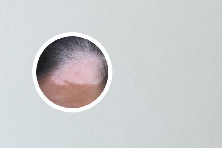 紫外线照射治疗白癜风价格