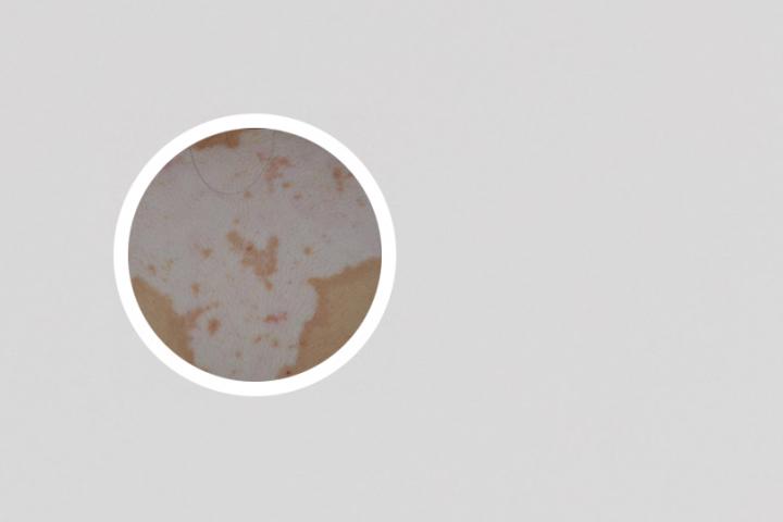 白癜风什么时候开始疼