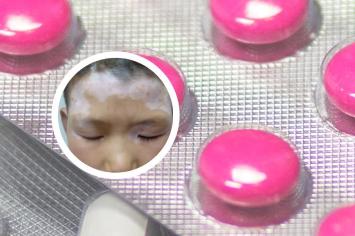 古人怎么治白癜风