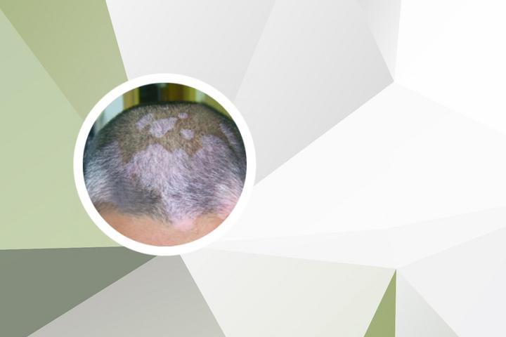 白癜风患者吃芋头好吗