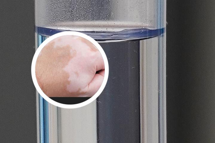 白癜风手脸腿同时发病