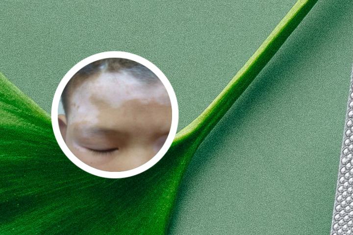 白癜风晚上最晚几点睡觉