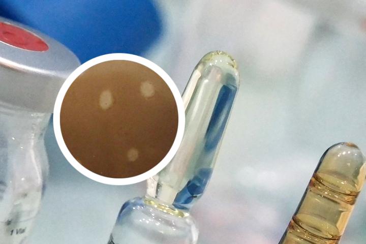白癜风的检查流程
