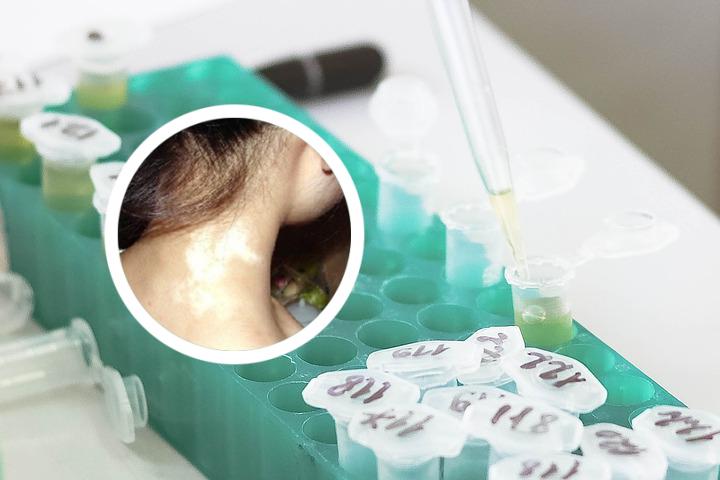 西安白癜风专科首推远大