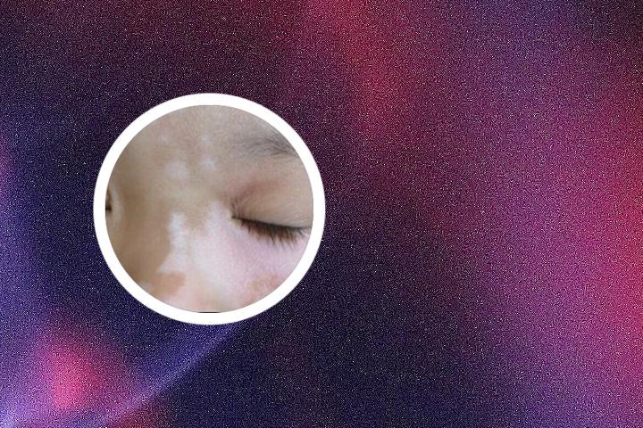 哪些中药能预防白癜风