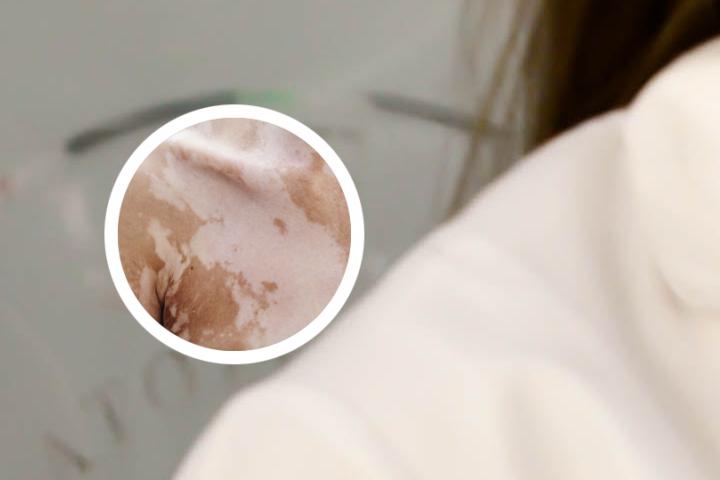 广东治疗白癜风正规医院