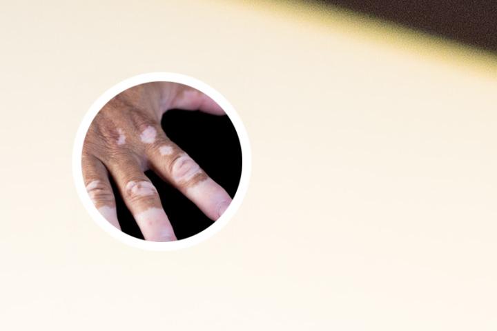 白癜风光疗多久才能治愈