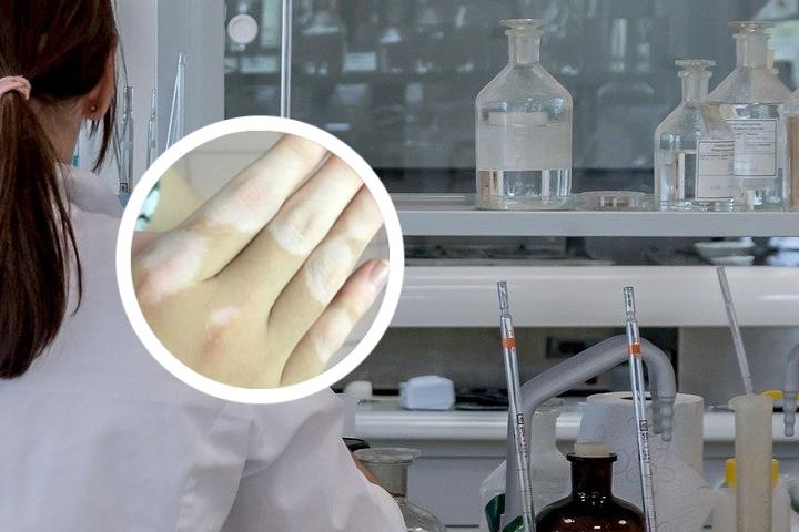 白癜风如何避免进一步扩散