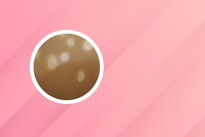 杭州治疗白癜风试丽都