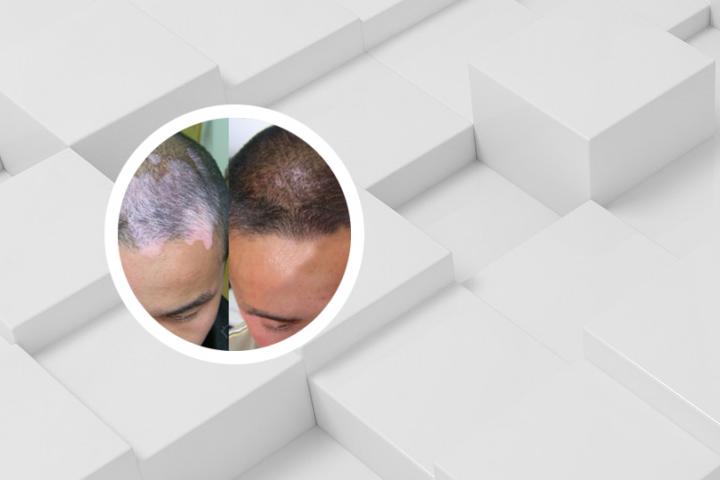 白癜风的患者可以吃红薯吗