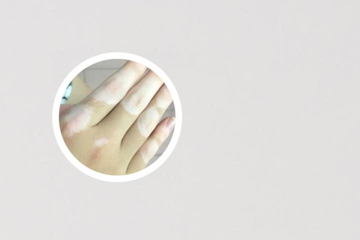 惊吓也会引起白癜风吗