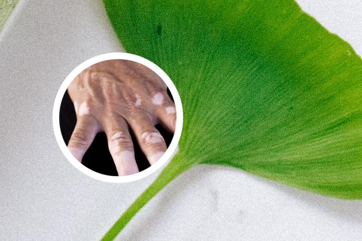 如何治好白癜风